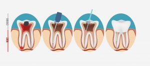 basic-root-canal-process-diagram