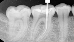 Advantages of Root Canal Treatment