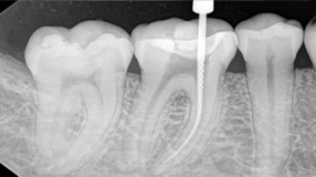 best-root-canal-dentist-nyc-endodontics
