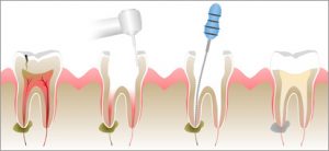 root canal