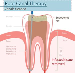 emergency root canal