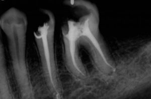 root canal