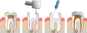 root canal