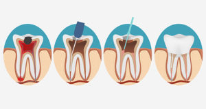 Root Canal 
