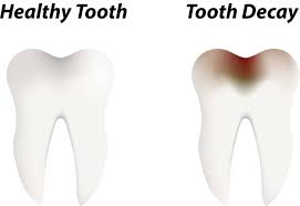 Prevent a root canal