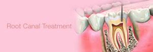 Root canal treatment