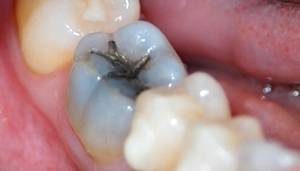 black-tooth-need-root-canal-03