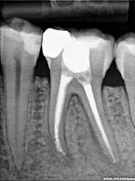 after-root-canal-expert-info-03