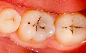 tooth that needs root canal