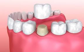 root-canal-crown-endodontist-contact-01