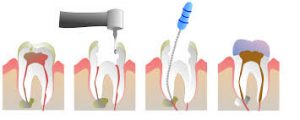 root-canal-steps-graphic-nyc-expert-dentist-02