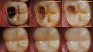 why-do-i-need-root-canal-01