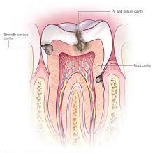 all-about-cavities-top-endo-nyc-01