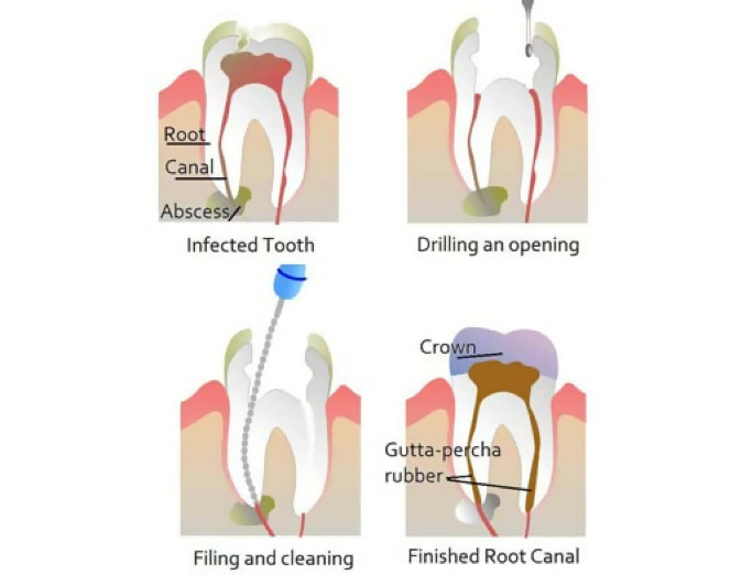 I Have A Failed Root Canal What Do I Do Best Root Canal Specialist Nyc ...