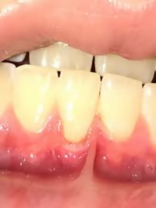 Root Canals In Molars and Incisors - Endodontist NYC 02