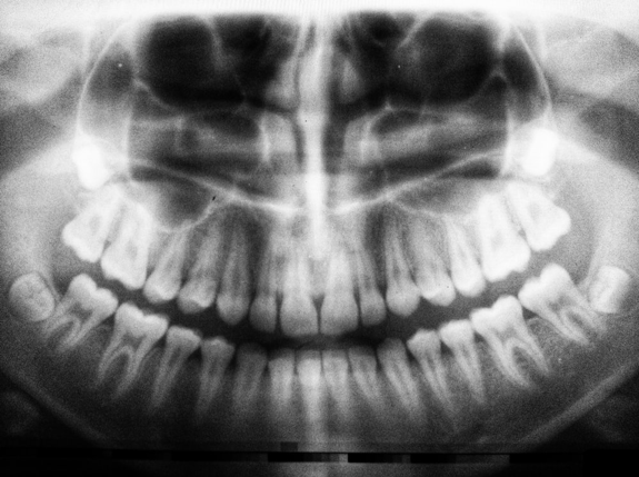 Do All Dentists Perform Root Canals? | 2021