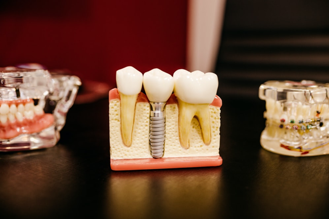 Tools Used in a Root Canal