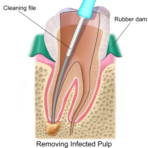 root canal process