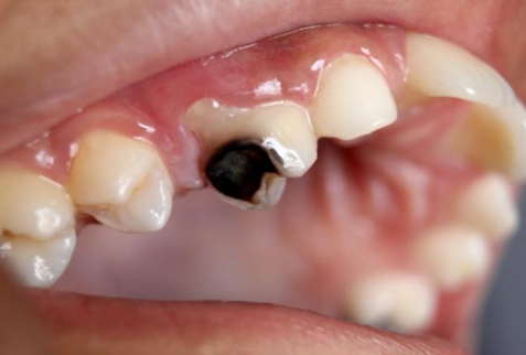 Tooth Pain Cavity or Root Canal?