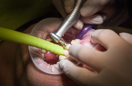 When is a Root Canal Necessary?