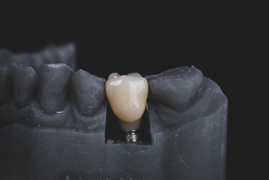 Dental Crowns