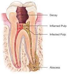 Description of Root Canal Process | Root canal tooth cross section