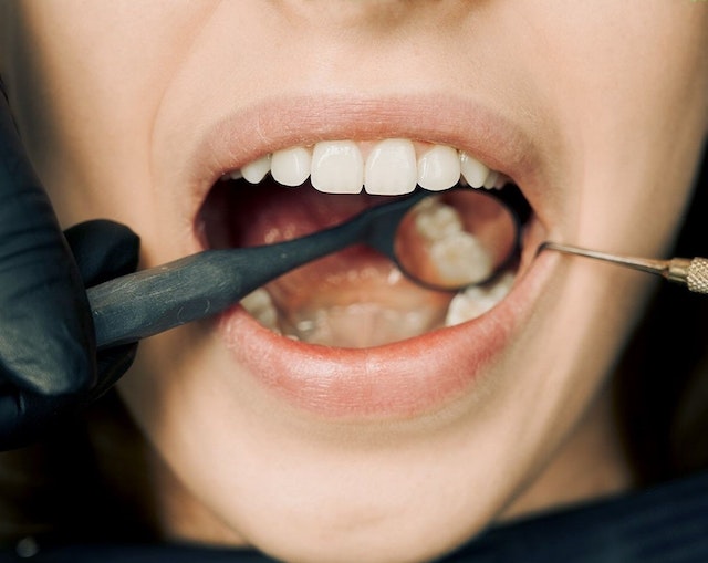 Myths and Misconceptions About Root Canals