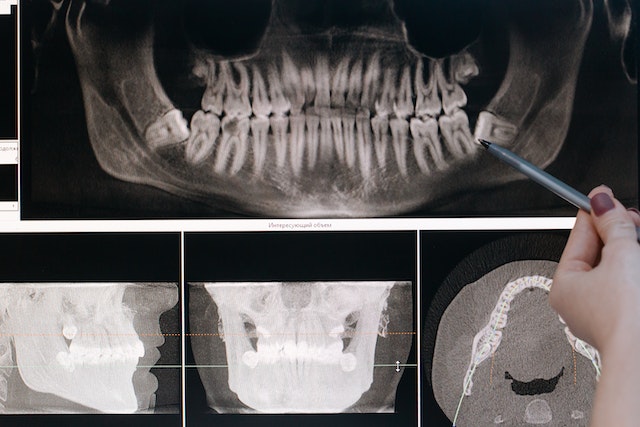 The Root Canal Process x rays